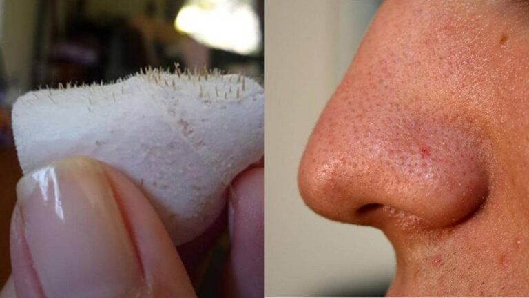Cette méthode simple transforme votre peau et élimine les points noirs…