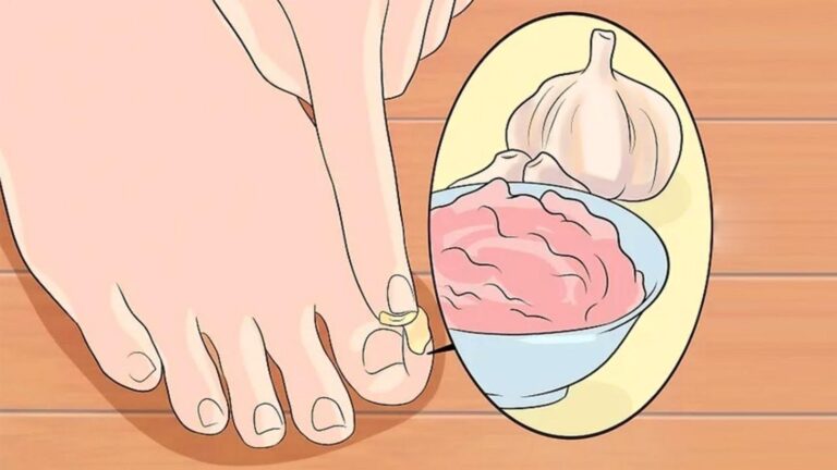 Cette astuce surprenante avec de l&rsquo;ail transforme vos pieds en un rien de temps…