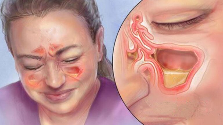 Cette méthode surprenante pour apaiser les sinus va changer votre quotidien…