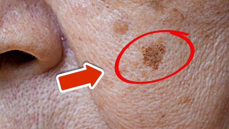 Éliminez 5 taches de vieillesse en une nuit avec ce remède secret !