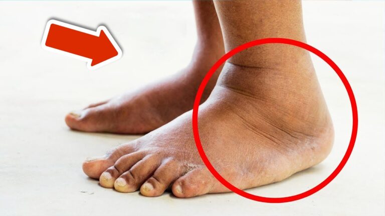 5 astuces pour réduire rapidement les gonflements des jambes et des pieds