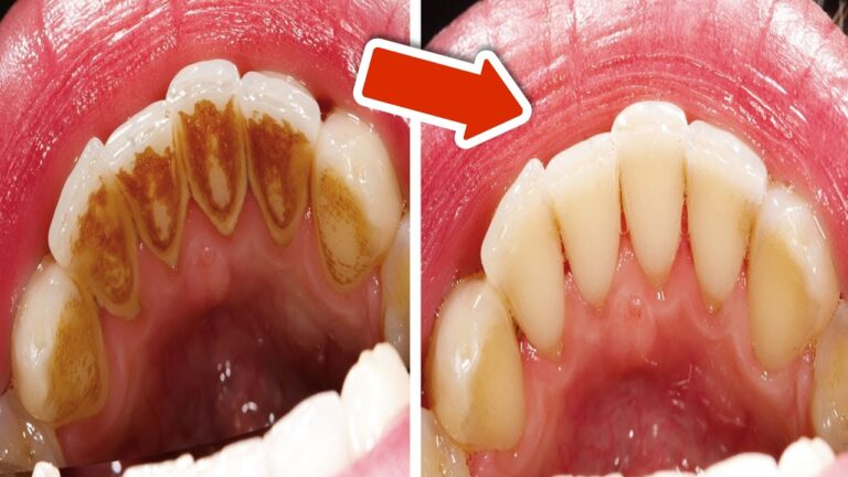 5 astuces simples pour enlever le tartre dentaire sans dentiste !