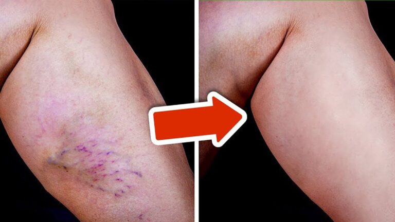 3 astuces pour éliminer les varices rapidement sans chirurgie !