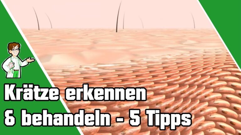 Découvrez les 5 astuces incontournables pour reconnaître et traiter la Krätze !