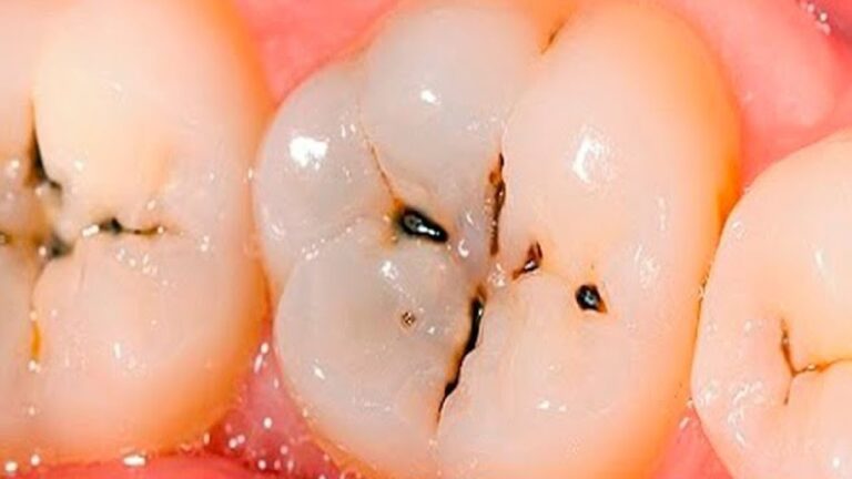 Combattez les caries : 5 étapes essentielles pour un sourire éclatant !