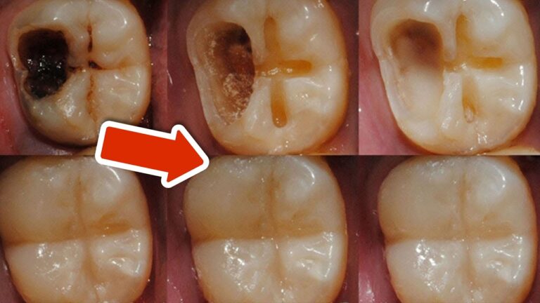 Stoppez le déclin dentaire : 5 astuces simples à essayer dès aujourd&rsquo;hui !
